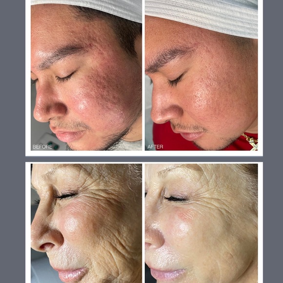 PROFESSIONAL GRADE MICRO-EXFOLIATION PEN MADE BY BIO-THERAPEUTIC - Picture 5 of 13